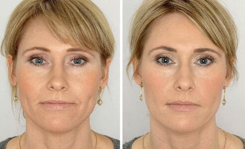 Photos before and after using the cream, the experience of using Coralift Valerie from Paris