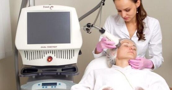 Fractional rejuvenation using lasers