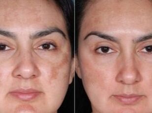 Before and after rejuvenation process